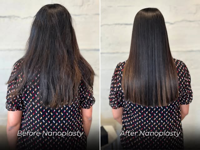 Before and after Nanoplasty.